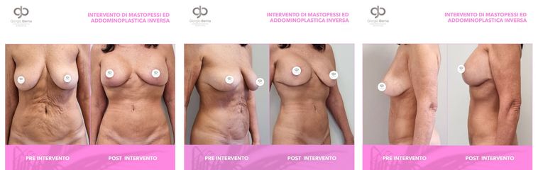 Dott. Giorgio Berna Mastopessi e Addominoplastica