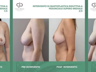 Mastoplastica riduttiva prima e dopo - 873128