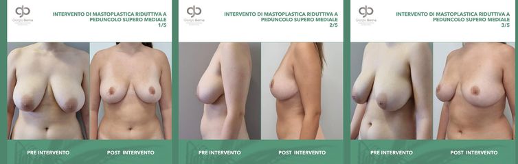 Dott. Giorgio Berna Mastoplastica Riduttiva