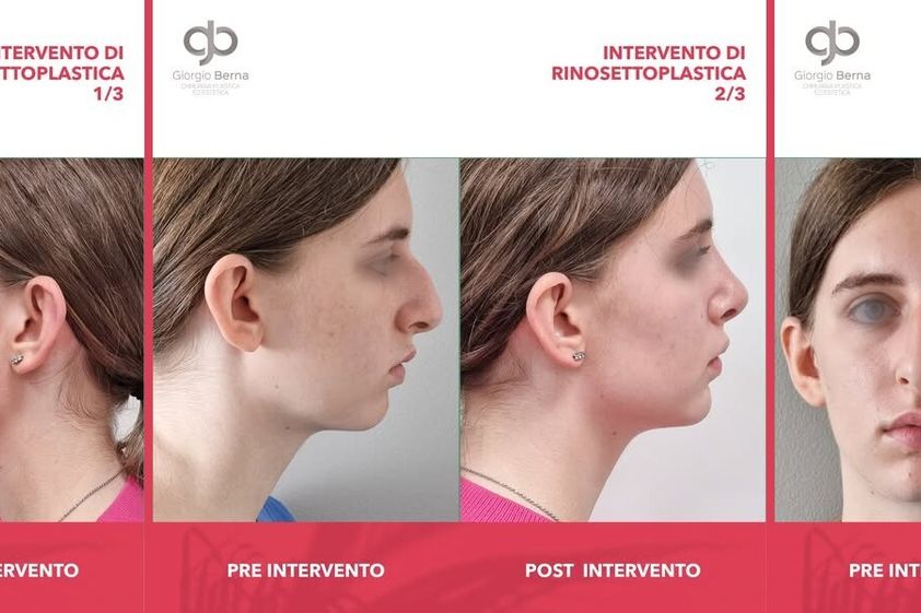 Rinoplastica prima e dopo - 873129