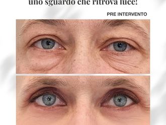 Blefaroplastica prima e dopo - 880586