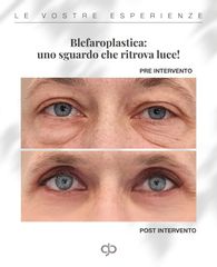 Blefaroplastica - Dott. Giorgio Berna