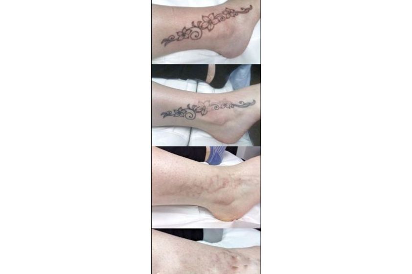 Rimozione tatuaggi prima e dopo - 773495