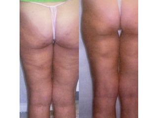 Cellulite - Dott. Virgilio Medical Laser