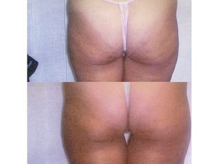 Cellulite - Dott. Virgilio Medical Laser