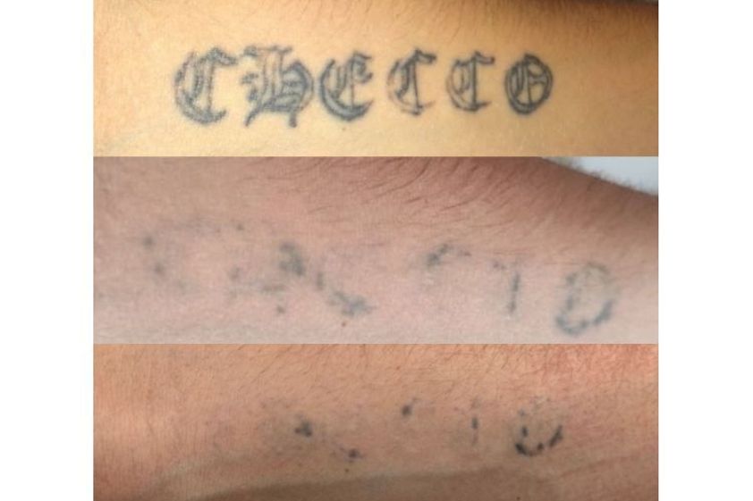 Rimozione tatuaggi prima e dopo - 788537