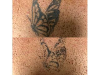Rimozione tatuaggi - Dott. Virgilio Medical Laser