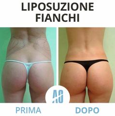 Liposuzione - Dott. Orlandi Alberto