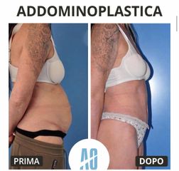 Addominoplastica - Dott. Orlandi Alberto
