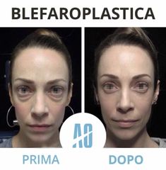 Blefaroplastica - Dott. Orlandi Alberto