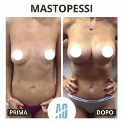 Mastopessi - Dott. Orlandi Alberto