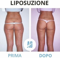 Liposuzione - Dott. Orlandi Alberto
