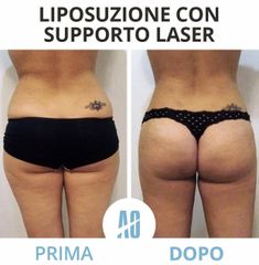 Liposuzione - Dott. Orlandi Alberto