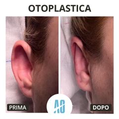 Otoplastica - Dott. Orlandi Alberto