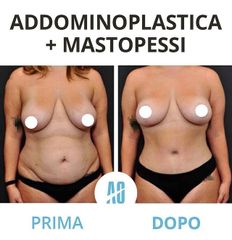Addominoplastica - Dott. Orlandi Alberto