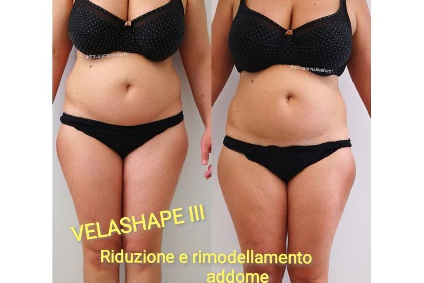 Velashape prima e dopo - 770181