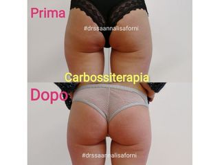 Carbossiterapia prima e dopo