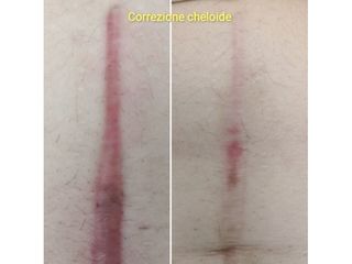 cheloide prima e dopo