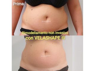 Velashape prima e dopo