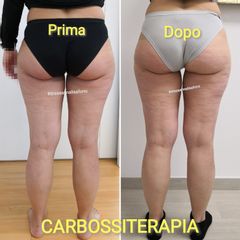 Carbossiterapia prima e dopo