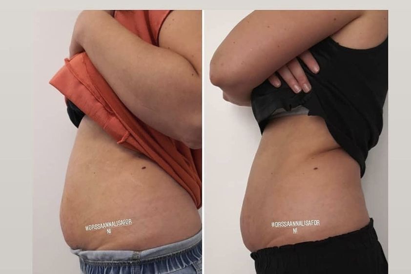 Velashape prima e dopo - 774872