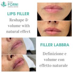 Filler labbra - Dott.ssa Annalisa Forni Medical Center