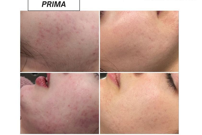 Needling prima e dopo - 866740