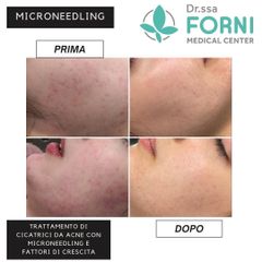 Microneedling - Dott.ssa Annalisa Forni Medical Center