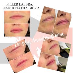 Filler labbra - Dott.ssa Annalisa Forni Medical Center