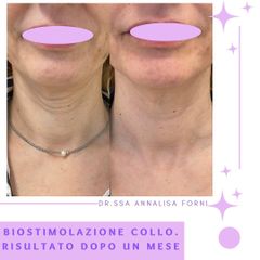 Biostimolazione - Dott.ssa Annalisa Forni Medical Center