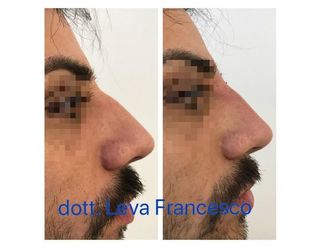 Rinoplastica - 305859