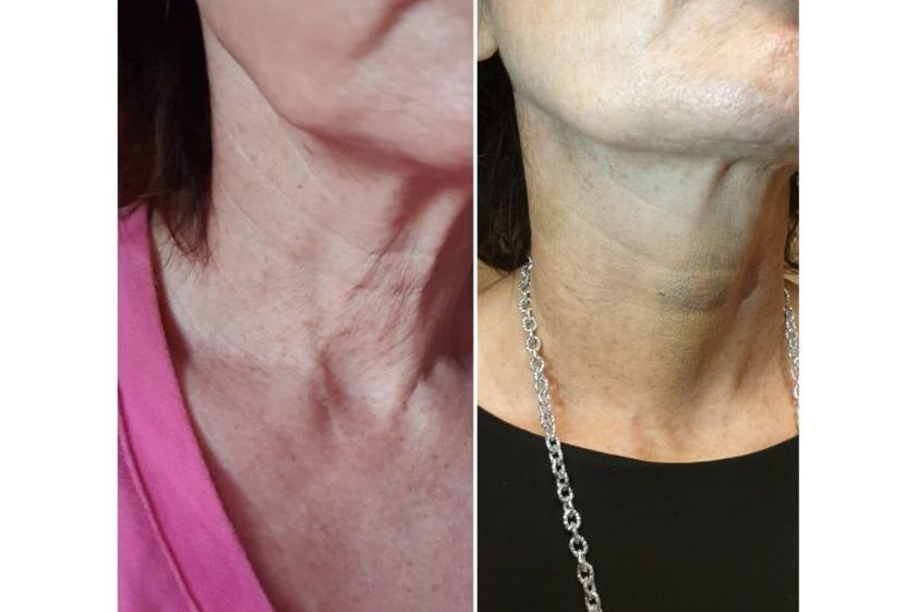 Fili riassorbibili prima e dopo - 769650