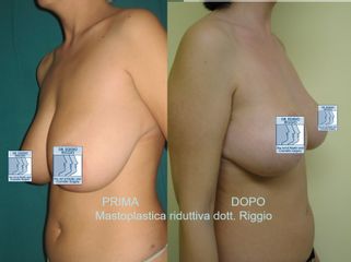 Riduzione seno verticale con tecnica conservativa ghiandola  dr-riggio prima e dopo 2anni