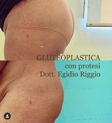 Gluteoplastica - Dott. Egidio Riggio