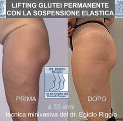 Gluteoplastica - Dott. Egidio Riggio