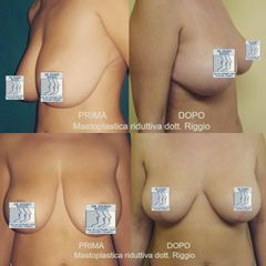 Mastopessi - Dott. Egidio Riggio
