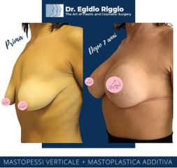 Mastopessi - Dott. Egidio Riggio