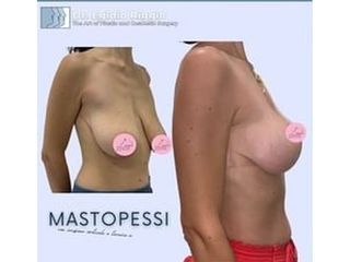 Mastopessi - Dott. Egidio Riggio