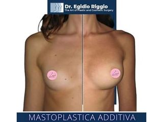 Mastoplastica additiva - Dott. Egidio Riggio
