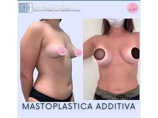 Mastoplastica additiva - Dott. Egidio Riggio