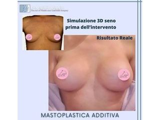 Mastoplastica additiva - Dott. Egidio Riggio