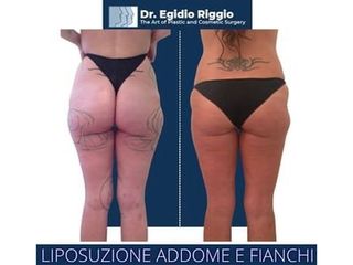 Liposuzione - Dott. Egidio Riggio