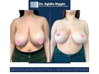 Mastoplastica additiva - Dott. Egidio Riggio