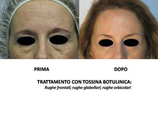 botox prima dopo