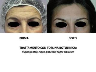 botox prima dopo