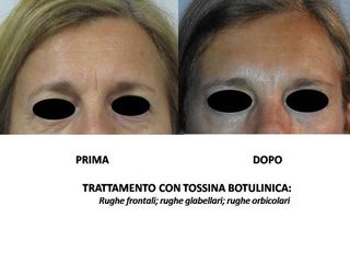 botox prima dopo