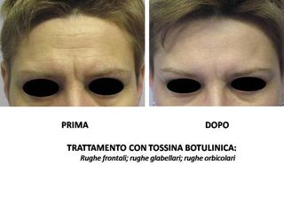 botox prima dopo