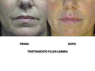 Filler labbra prima dopo