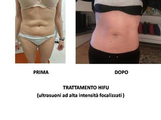 HIFU prima dopo