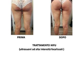HIFU prima dopo
